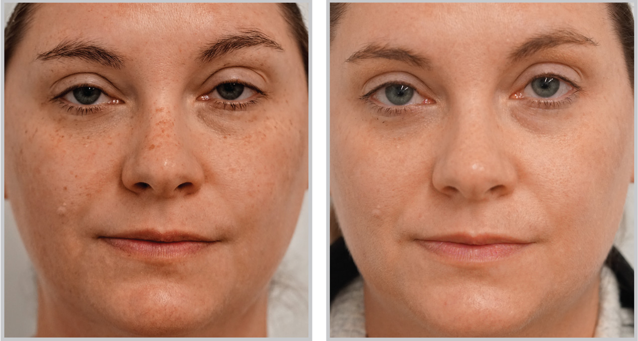 Before and after Forever Young BBL treatment showing reduced freckling and sun spots on the cheeks