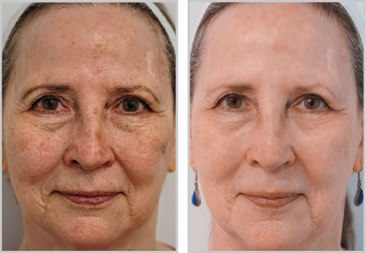 Before and after Forever Young BBL treatment showing reduced facial pigmentation and more even skin tone