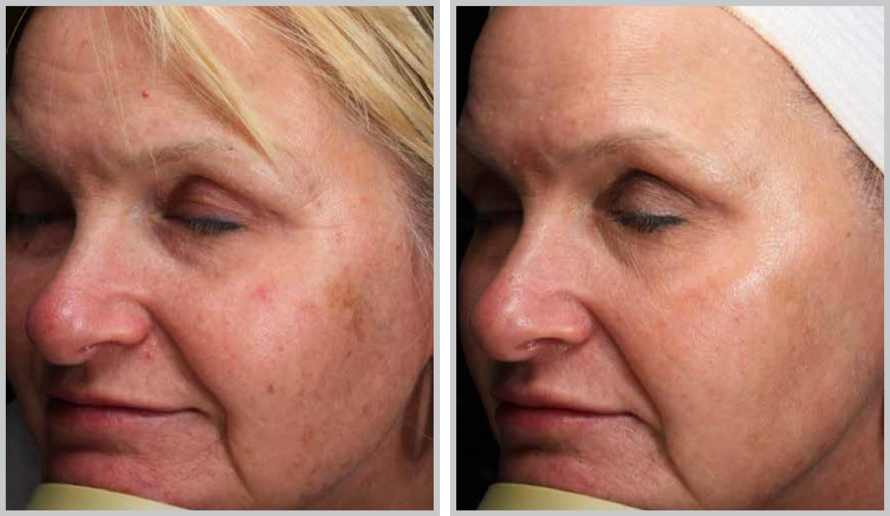 Before and after Forever Young BBL treatment showing cleared brown sun spots on the cheek