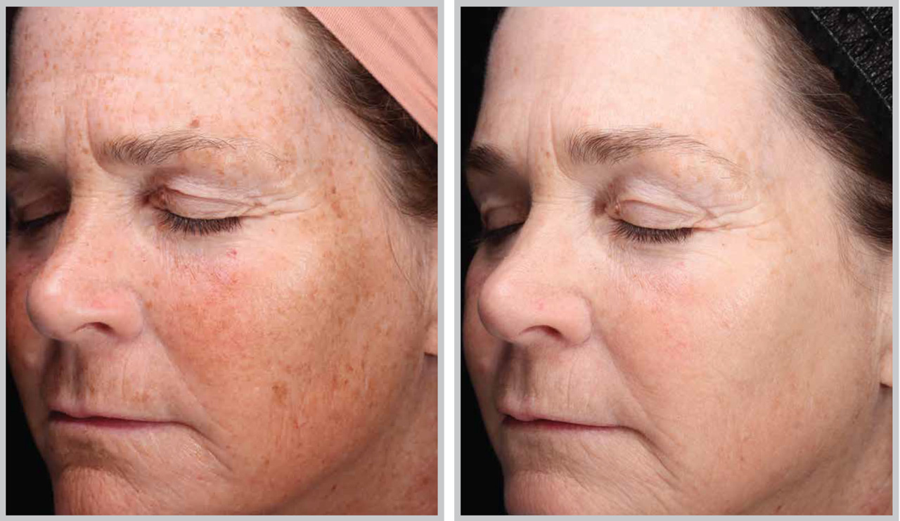 Before and after Forever Young BBL treatment showing reduced sun damage and facial redness