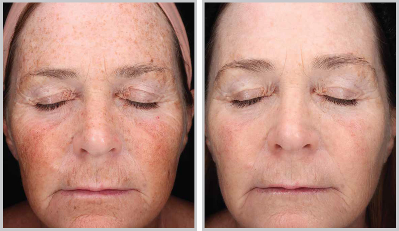 Before and after Forever Young BBL treatment showing reduced pigmentation and redness across the face