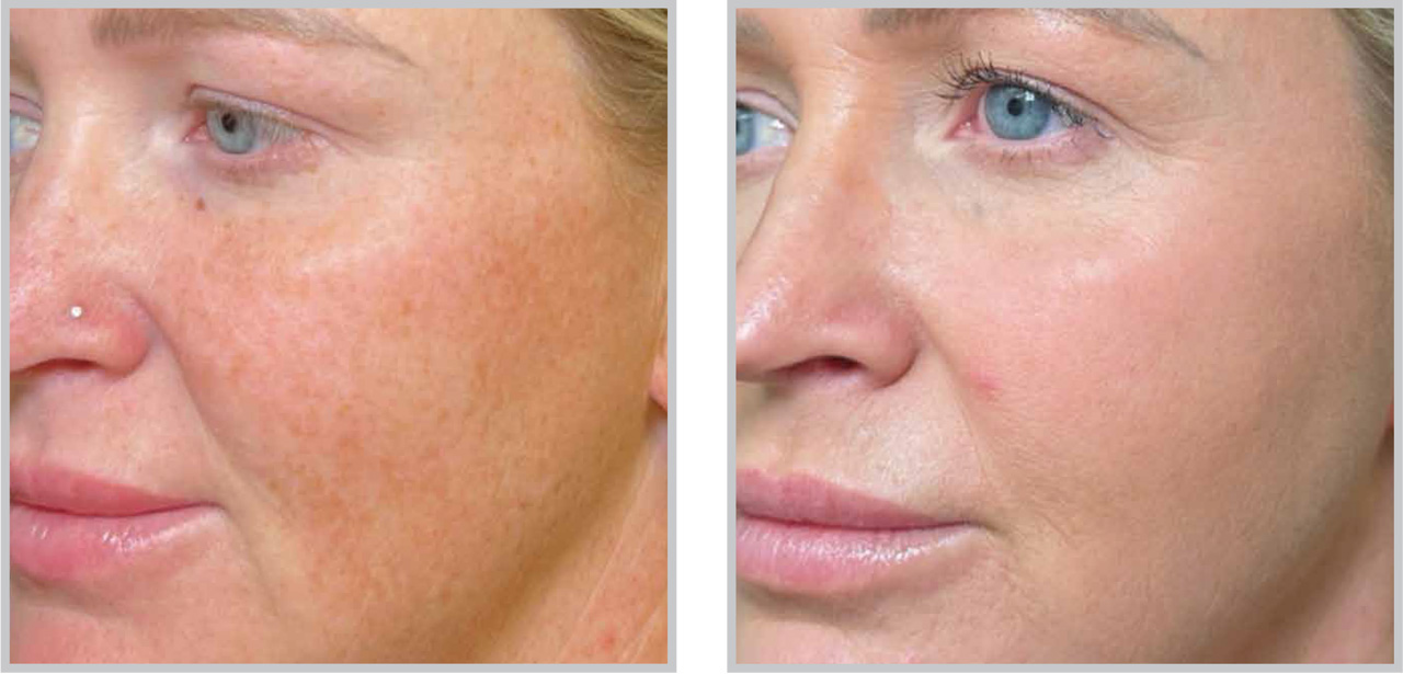 Before and after Forever Young BBL treatment showing clearer skin with diffuse pigmentation reduced