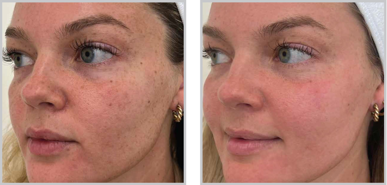Before and after Forever Young BBL treatment showing reduced freckling and clearer, brighter skin