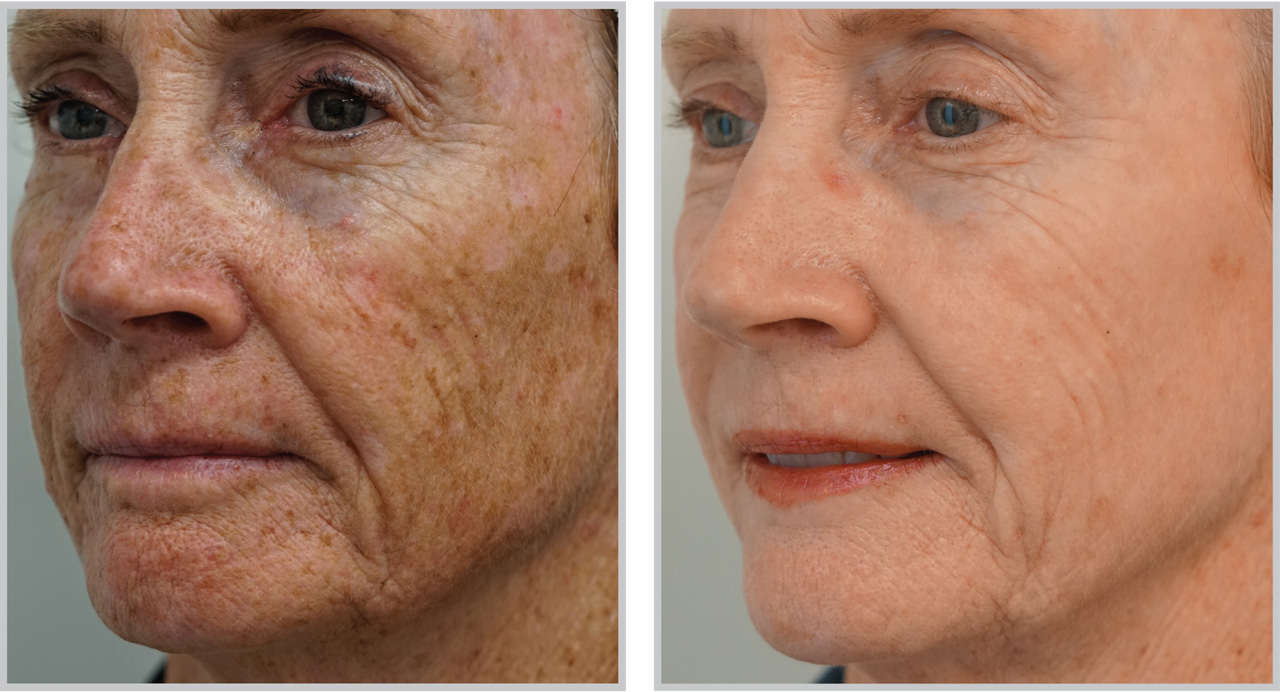 Before and after Forever Young BBL treatment showing significantly reduced advanced sun damage and pigmentation